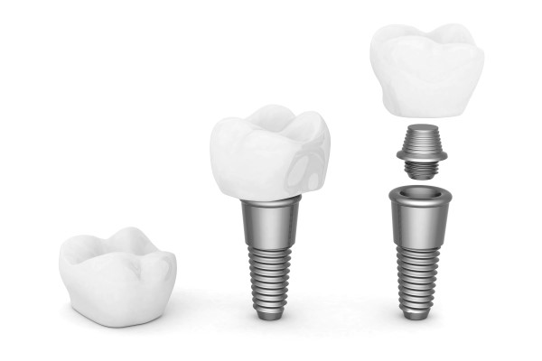 Questions To Ask A Dentist About Implant Crowns